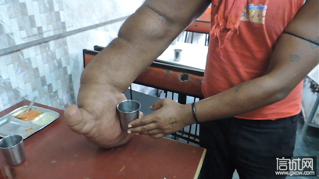 印小伙患罕见巨手症