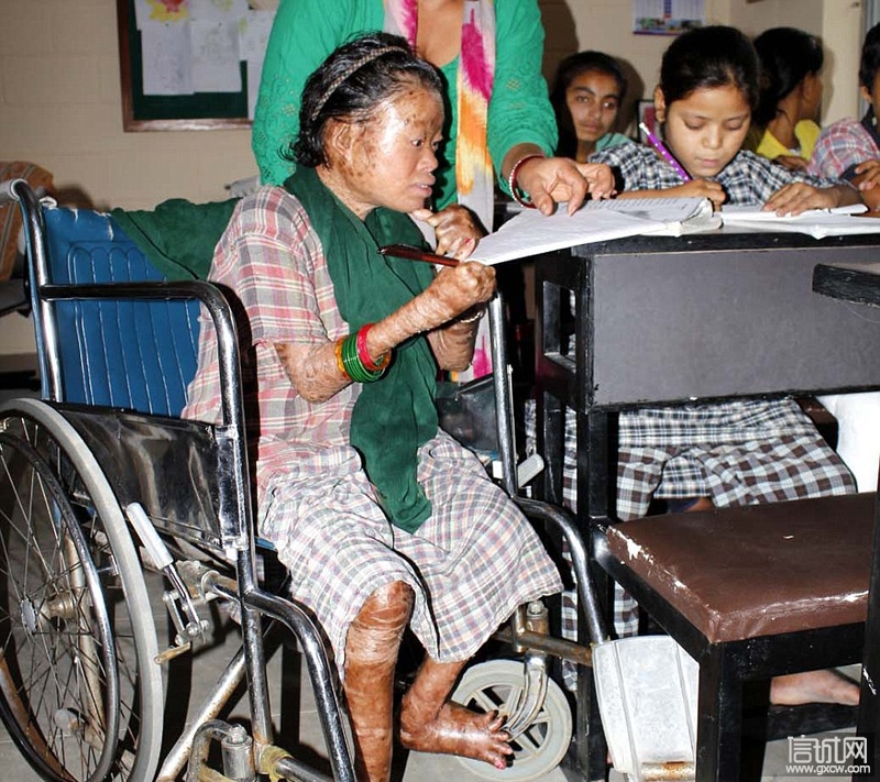 尼泊尔少女患怪病 全身长满鱼鳞癣