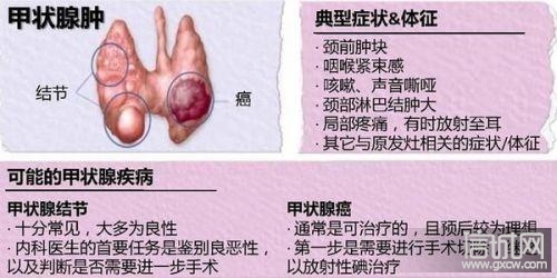 甲状腺结节如果不治疗,会很严重吗?