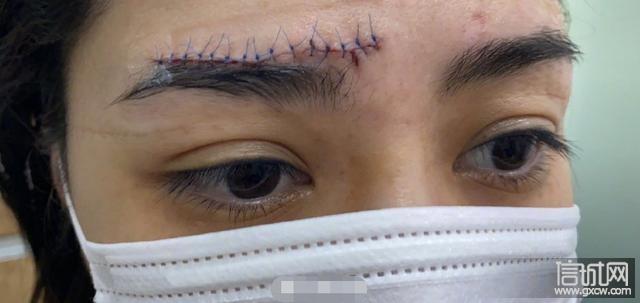 阿娇受伤之后一直备受质疑,许多网友觉得她是在利用自己的伤口炒热度